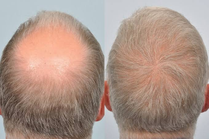 hair transplant before and after