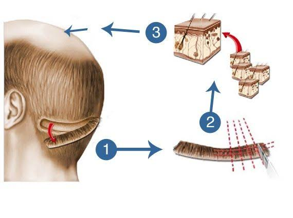 fut hair transplant procedure steps.